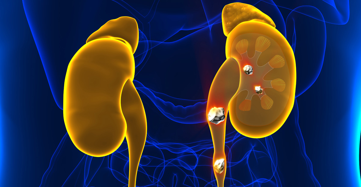 cross-section-illustration-of-kidney-stones-Dr.-Ross-Moskowitz