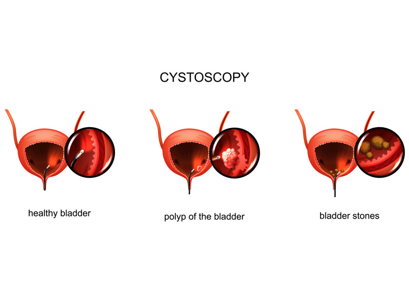 cystoscopy-of-the-bladder-Dr.-Ross-Moskowitz