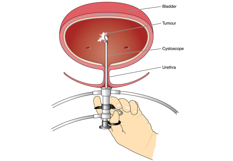 illustration-of-cystoscopy-Dr.-Ross-Moskowitz