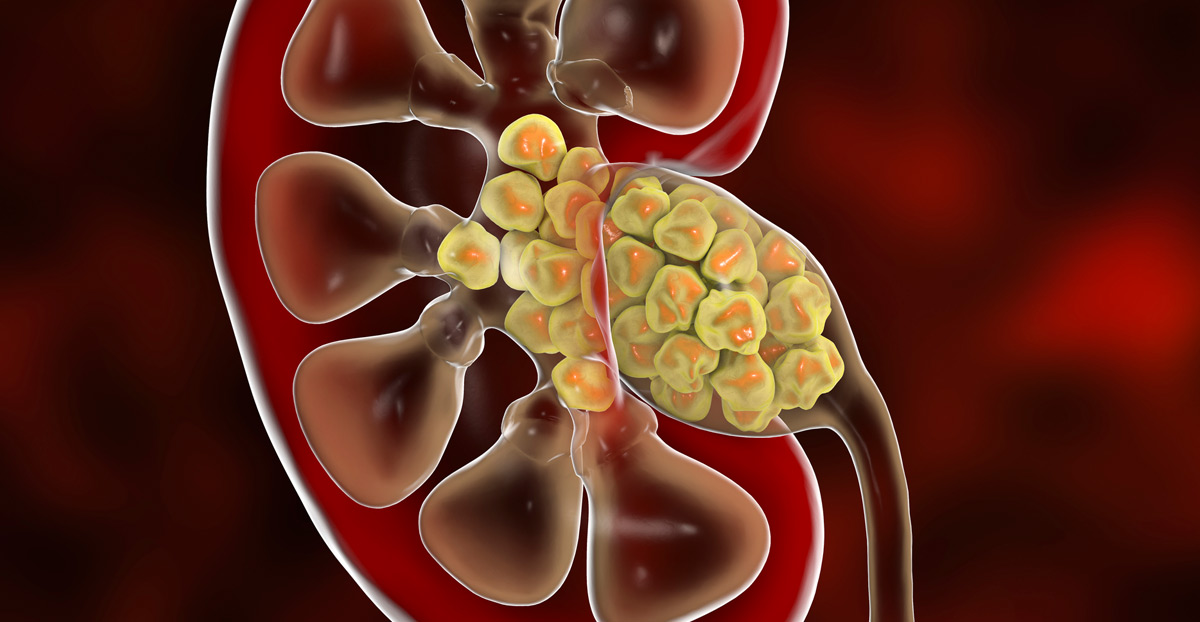 illustration-of-kidney-stones-before-percutaneous-surgery-Dr.-Ross-Moskowitz