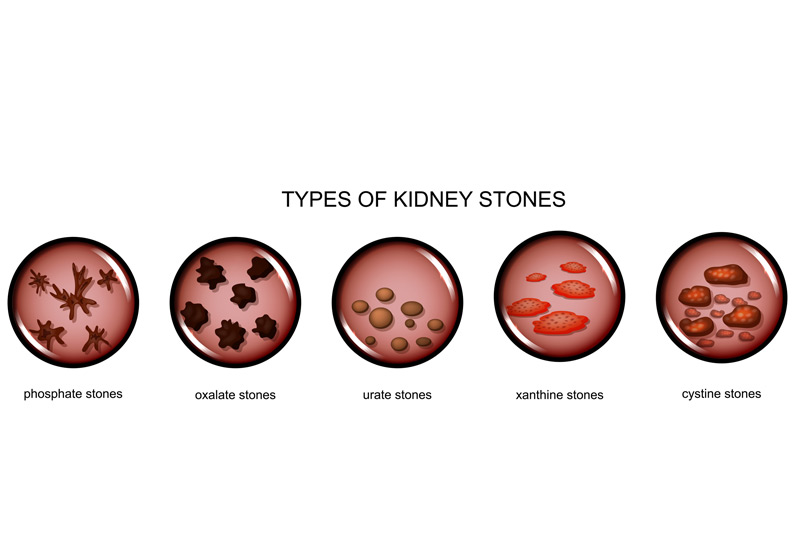 kidney-stones-can-be-treated-by-percutaneous-surgery-Dr-Ross-Moskowitz