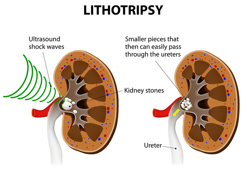 laser-lithotripsy-illustration-Dr.-Ross-Moskowitz