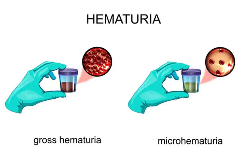 medical-concept-of-hematuria-Ross-Moskowitz
