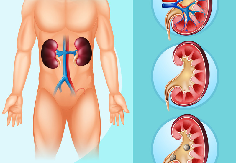 medical-concept-of-kidney-stones-before-percutaneous-surgery-Dr.-Ross-Moskowitz