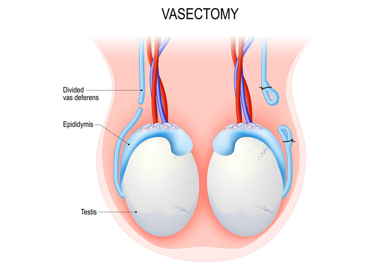 vasectomy-method-Dr-Ross-Moskowitz